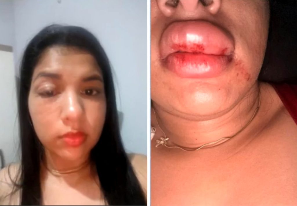 ‘Estou tendo que me esconder’, desabafa jovem agredida por vereador no Tocantins